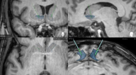 Primer estudio mundial de estimulación cerebral profunda para pacientes con esquizofrenia resistente al tratamiento