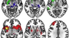 Identificados patrones de conexión en el cerebro relacionados con una predisposición al TOC - ¡Participa en el estudio!