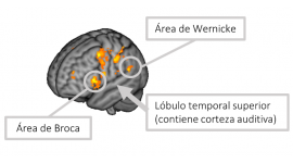 Localizadas las áreas cerebrales implicadas en uno de los principales síntomas de la esquizofrenia, las alucinaciones auditivas